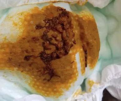 婴儿拉绿便的几种形状,宝宝拉绿便怎么鉴别