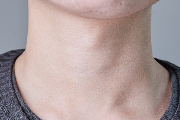 女人脖子后面的富贵包是什么原因,脖子后面的富贵包什么方法能去掉