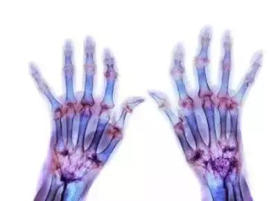 十年的类风湿还能治好需要多少钱,类风湿是不是永远治不好了