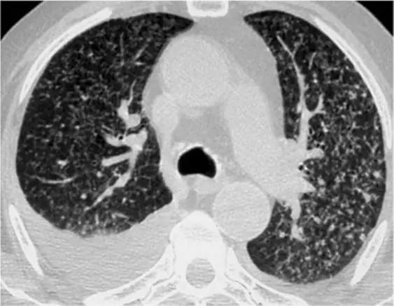 间质性肺疾病看病经验分享,分享肺腺癌临床实验的例子
