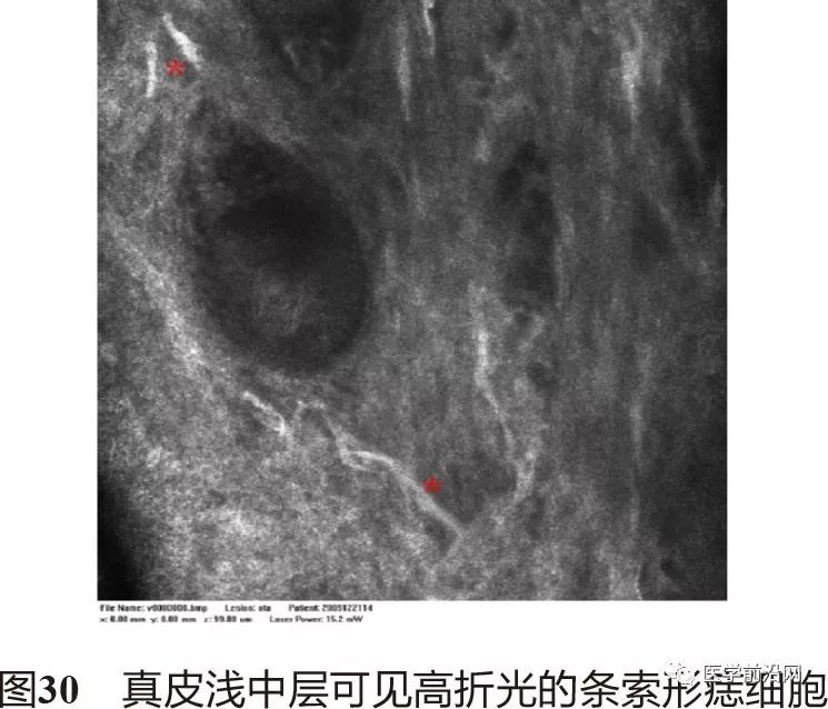 皮肤共聚焦显微镜能查什么,皮肤镜和共聚焦显微镜