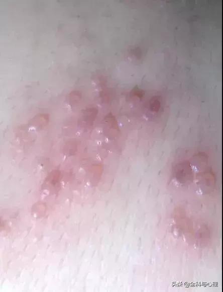 手上手臂起小水泡很痒是怎么回事,手上小水泡抓破了烂了一大片