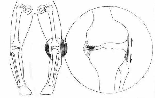 练就笔直大长腿，OX腿型如何应对？！｜运动康复003课