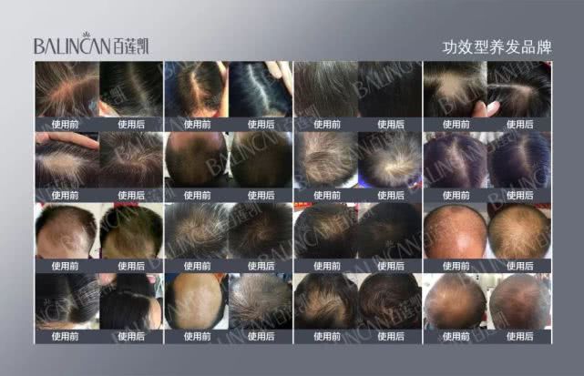 “让百万人告别脱发”l百莲凯倡导“第2届313世界生发节”