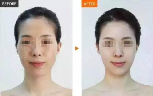 面部衰老改善最好的方法,衰老与面部轮廓的变化