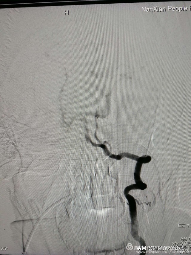 神经外科手术动脉瘤,湖南省人民医院脑动脉瘤介入治疗