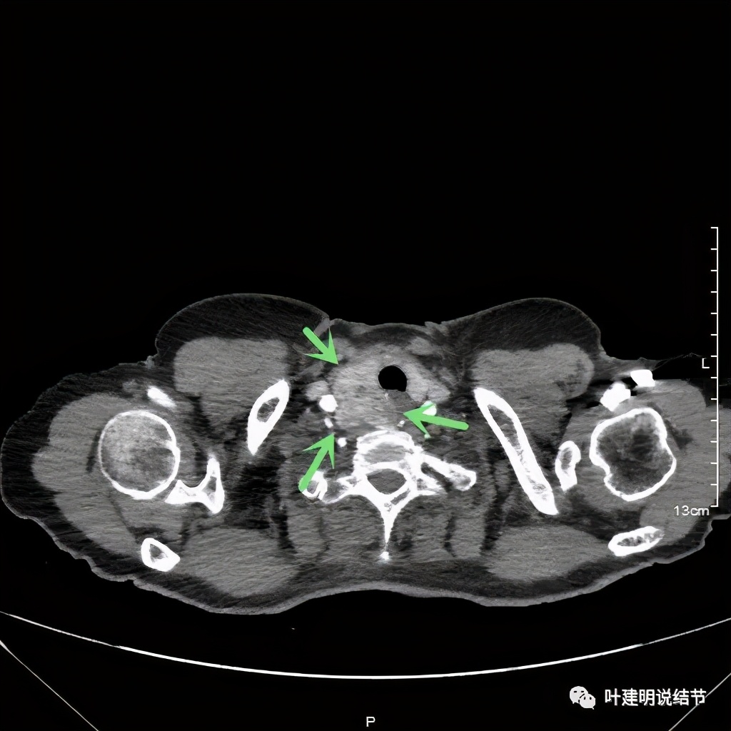 胸部高分辨ct检查注意事项,胸部ct扫描有没有危害