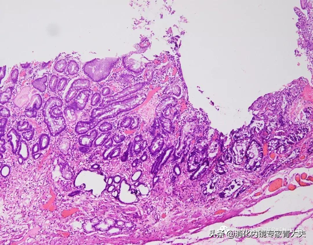 关于胃原位癌的科普文章,消化道早癌科普文章