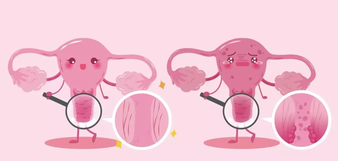 宫颈tct检查是什么还用做hpv吗,宫颈tct检查正常hpv会有问题吗