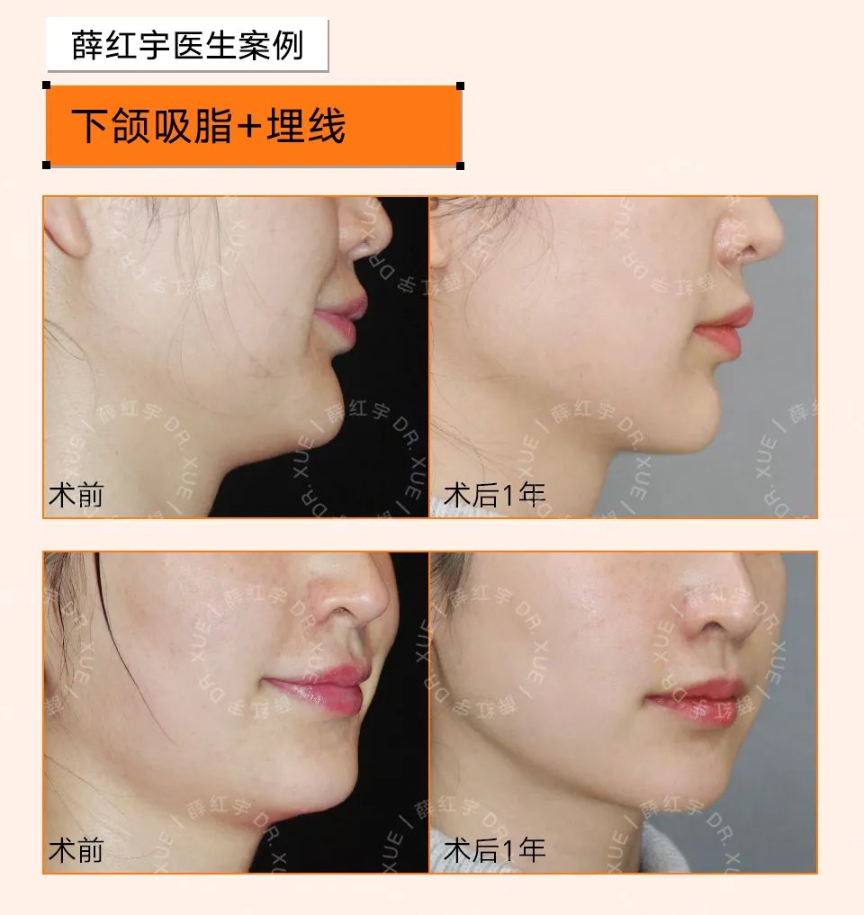 让下颚越来越清晰,下颌缘不清晰的原因