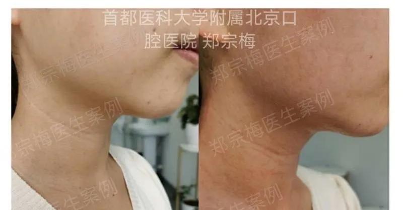 fotona4d有效果吗,fotona4d做完前后对比