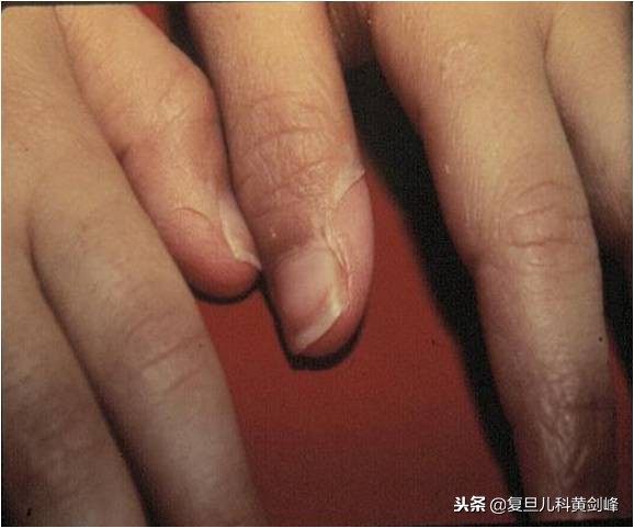 发热白细胞高单核细胞高,发热白细胞高达25什么原因