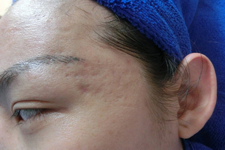 角质层薄是什么原因造成,敏感肌角质层薄怎么增厚角质层