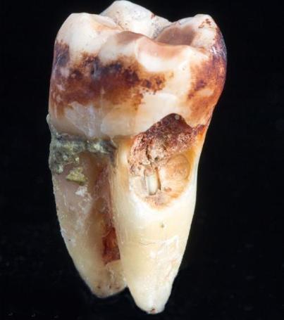 放大两千倍的牙齿表面长什么样？不愧是人体最脏的地方，不堪入目