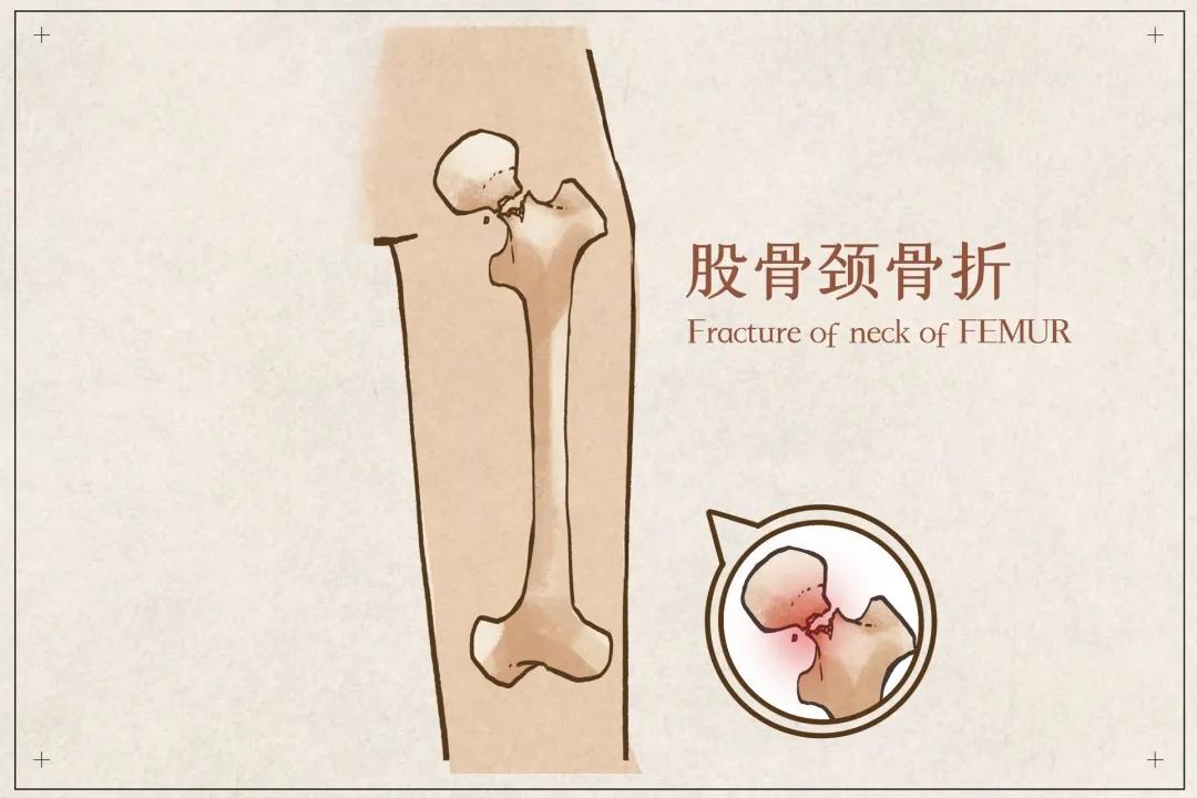 麦迪森健康：这种骨折堪称“人生最后一次骨折”，家有老人必读