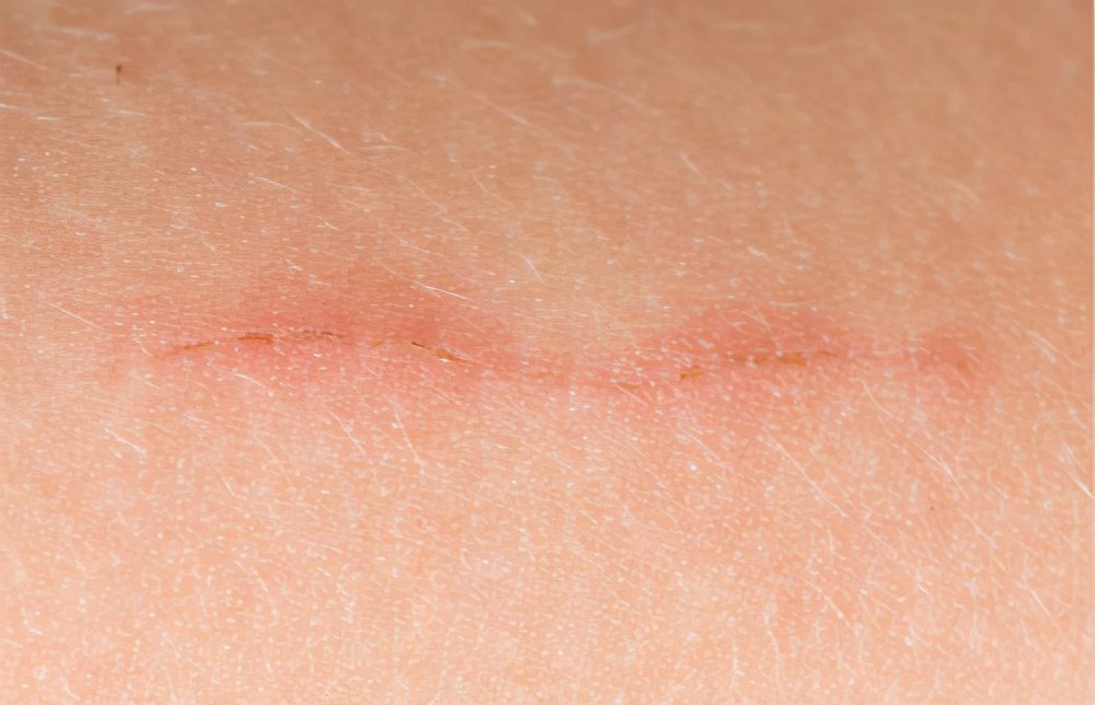 疤痕现在怎么治效果最好,疤痕问题解答