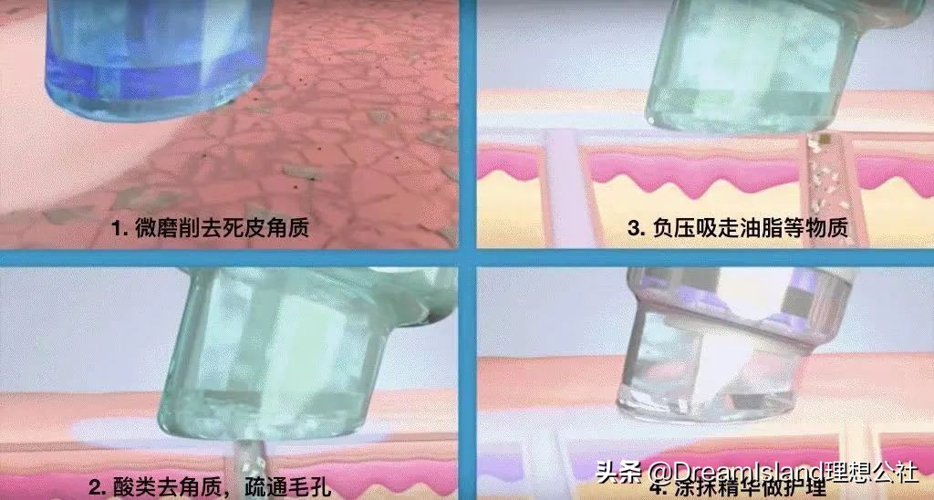 脸上有闭口毛孔粗大适合什么医美,毛孔粗大有闭口黑头该做什么医美