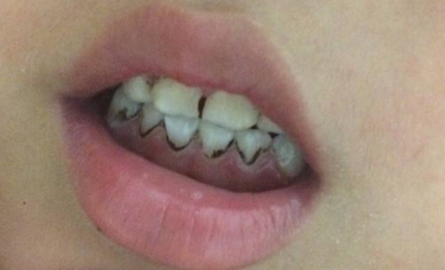 小孩可以洗牙视频,儿童可以洗牙吗洗牙的过程是什么