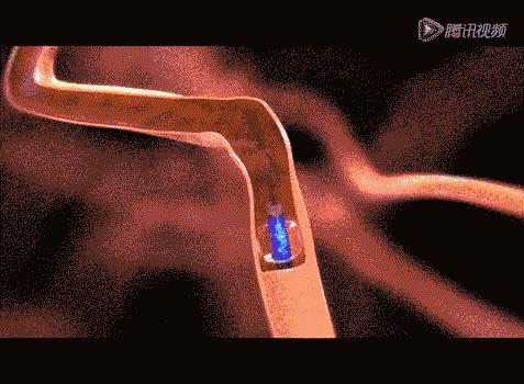 脑血管的清道夫——神奇取栓术