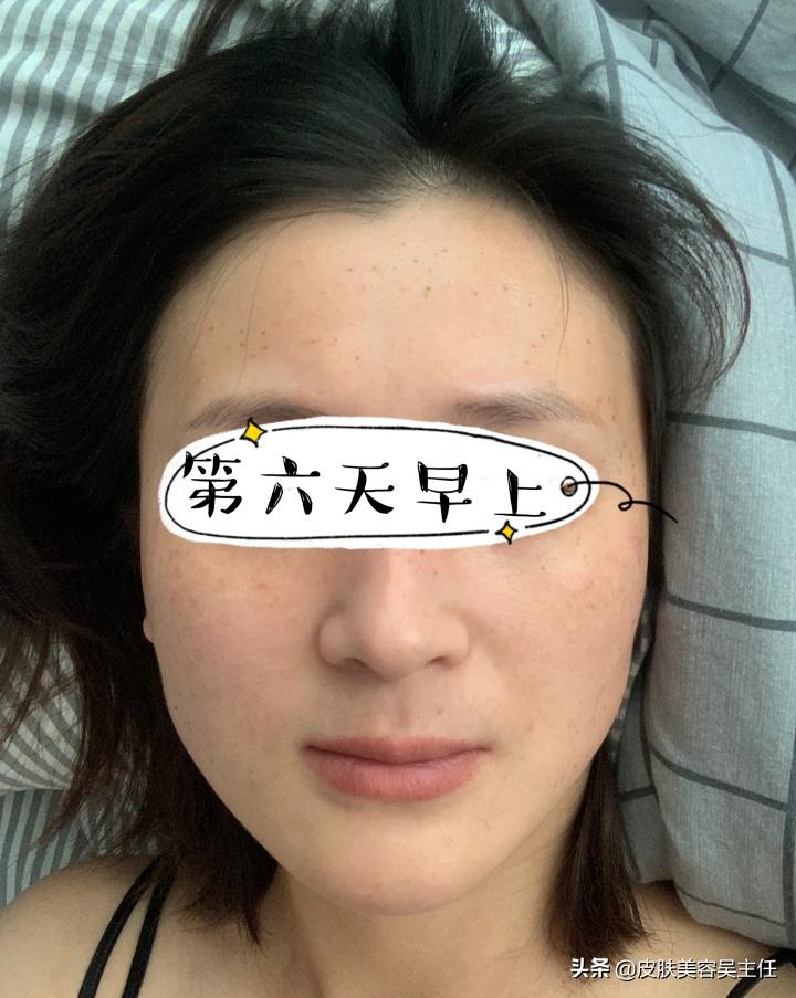 蜂巢皮秒英诺小棕瓶,脸上有斑的可以用英诺小棕瓶吗