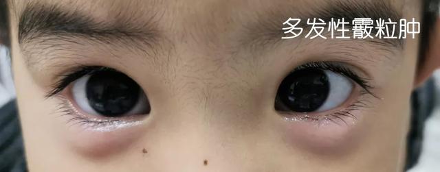 眼睛感染过后麦粒肿还是霰粒肿,眼皮红肿麦粒肿霰粒肿形成机理