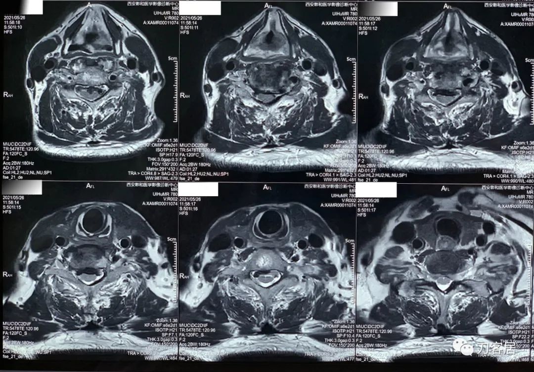 颈椎病椎间盘突出医生说先不手术,颈椎3-7节椎间盘突出怎么治疗