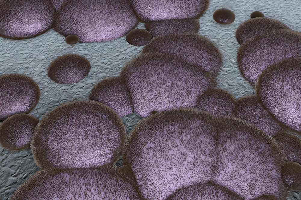 细菌感染眼球摘除,眼球摘除会不会再次真菌感染