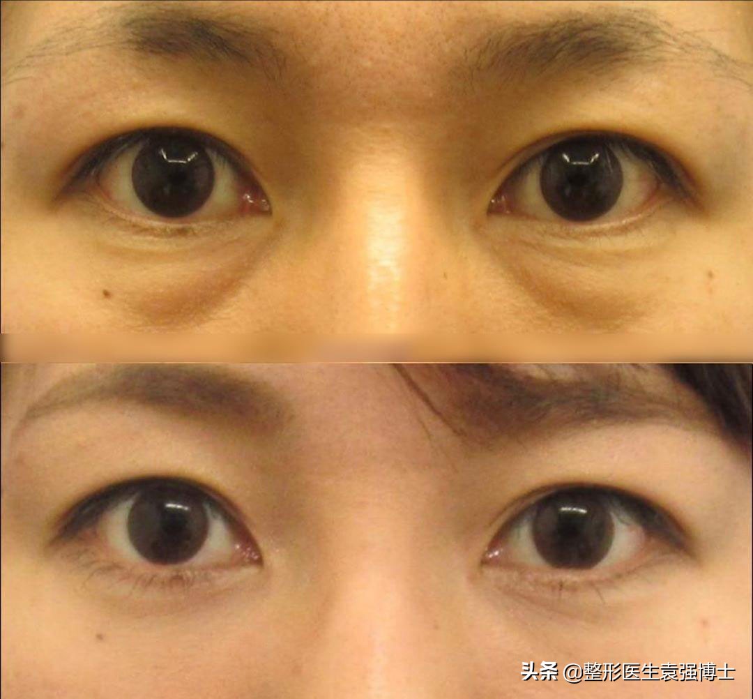 最简单最有效的祛眼袋方法,做了眼袋后悔