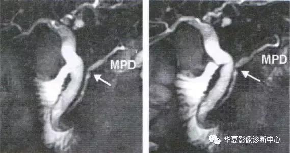 副胰管与主胰管图谱,主胰管型和分支胰管型如何鉴别