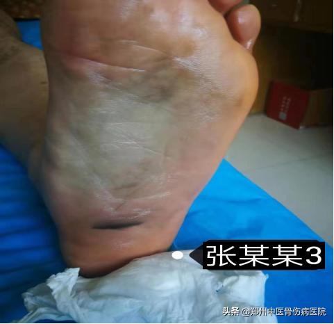 李氏砭法刮痧培训班在我院举办,铜砭虎符耳部刮痧手法视频教学