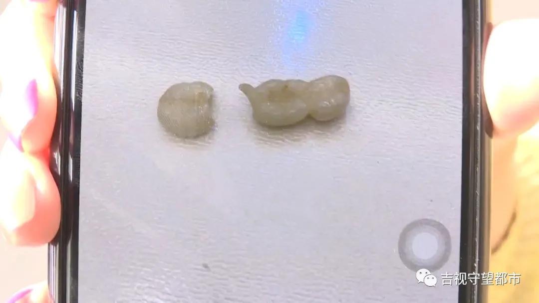 长春市最便宜的烤瓷牙多少钱,长春烤瓷牙做得好的口腔医院