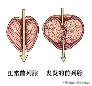 尿频尿痛前列腺炎偏方,尿频尿急前列腺炎偏方