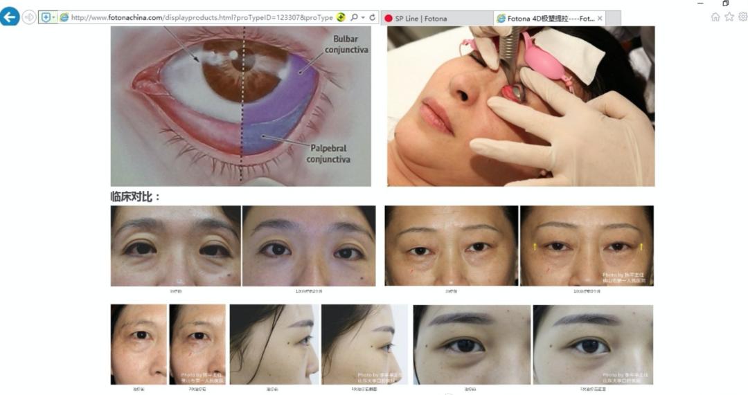 fotona4d效果真的好吗,fotona4d真的有效果吗