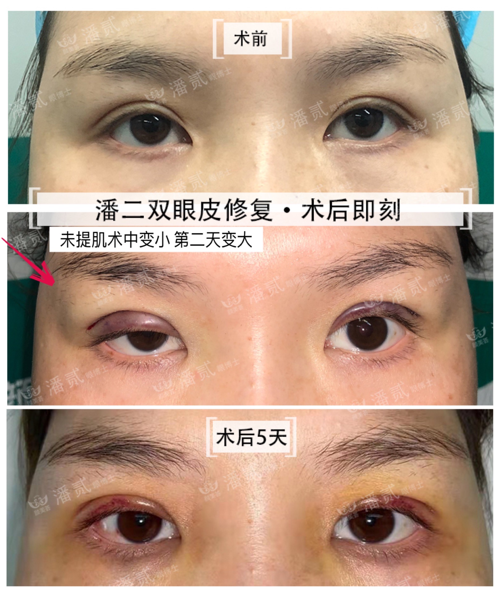 做过韩式三点双眼皮还能重新做吗,韩式三点双眼皮5年后修复