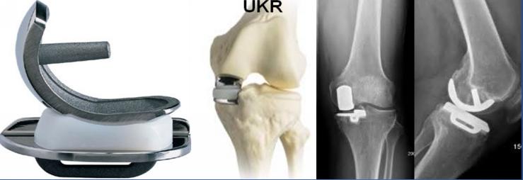 膝关节骨性关节炎症状及治疗,膝关节骨性关节炎诊疗指南下载