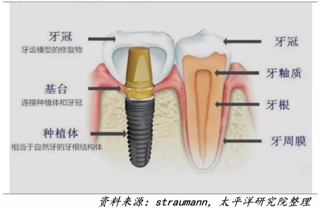 集采来了！我们离种牙自由还远吗？