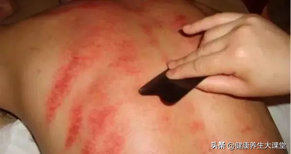 刮痧后的痧印情况比较分析总结，很全面，收藏起来学习