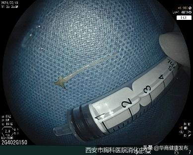 骨鲠,消化内镜可以做什么治疗