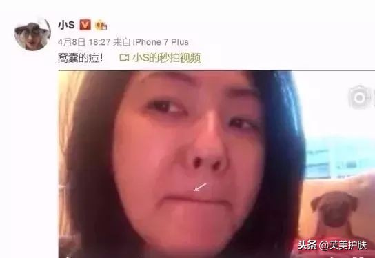 教你如何快速祛痘，成为无痘小仙女