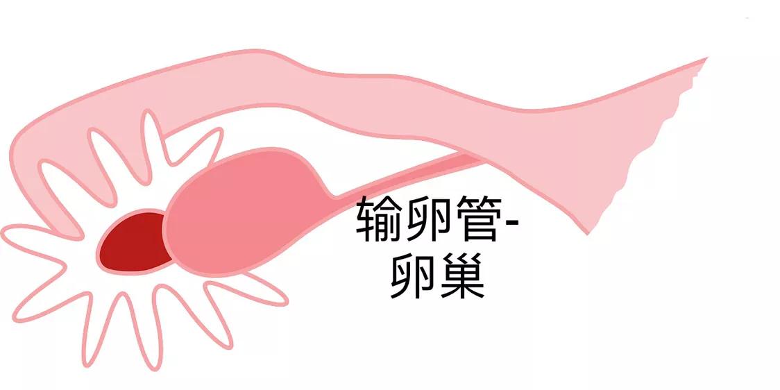 子宫内膜异位症痛经不孕怎么治疗,痛经会导致子宫内膜异位症