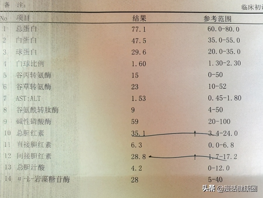 肝功的三项胆红素偏高医生说没事,胆红素三项高医生说没事让多喝水