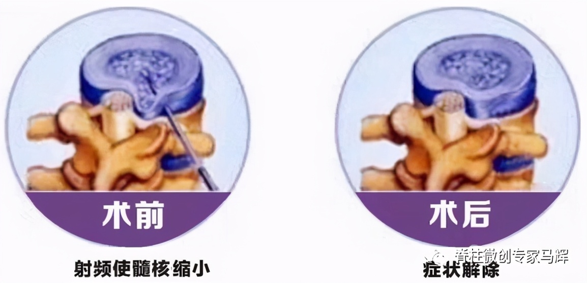 什么是盘源性腰痛,盘源性腰痛真实案例