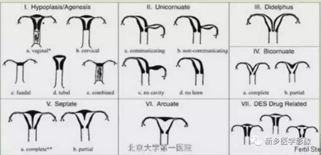 子宫发育异常，应想到的6大类常见畸形