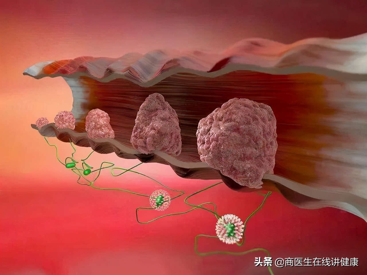 浸润癌是最严重的癌吗,浸润癌恶性