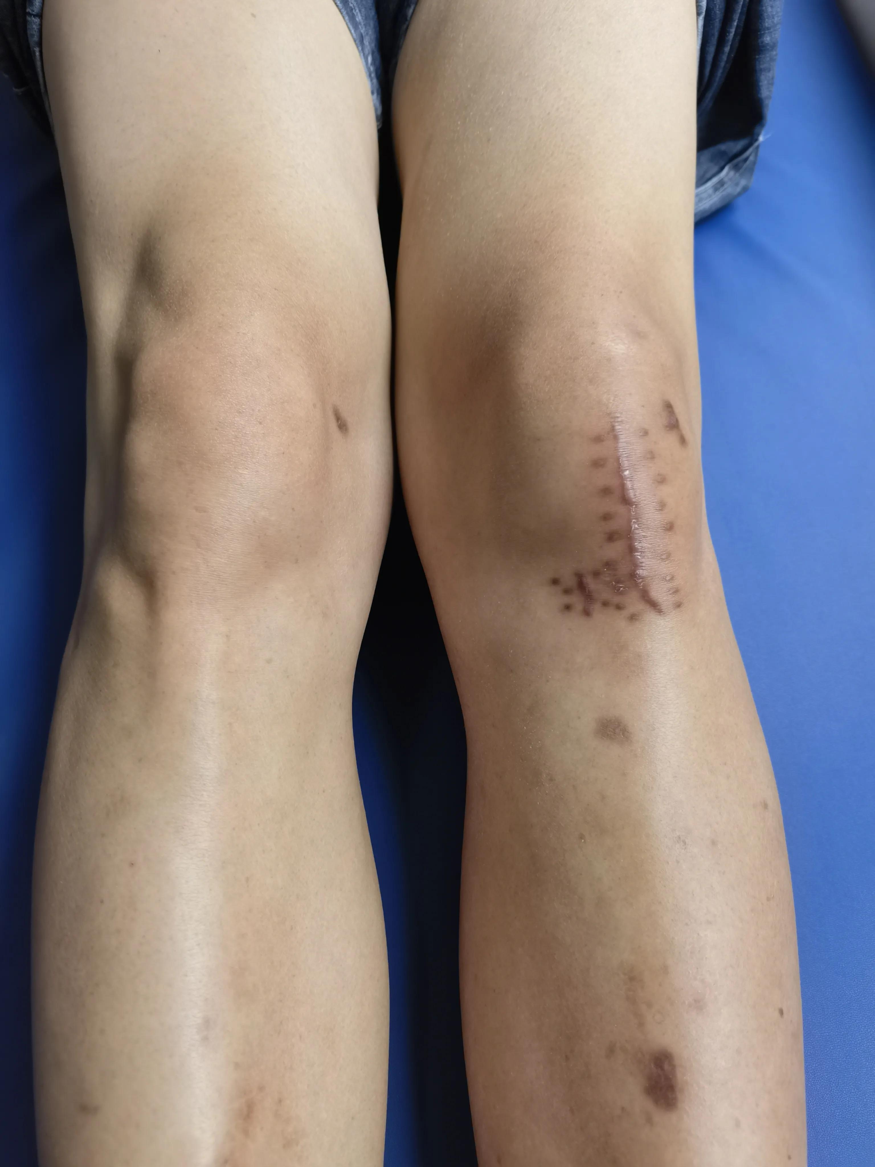 骨折后大腿部肌肉萎缩,大腿骨折后肌肉萎缩还会恢复吗