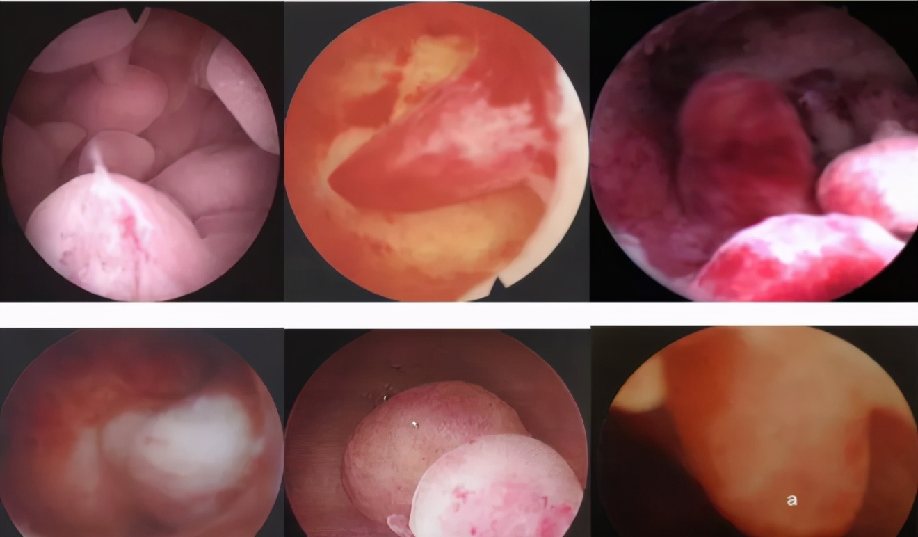 子宫内膜息肉诊刮多久可以怀孕,子宫内膜息肉手术后还是没怀孕