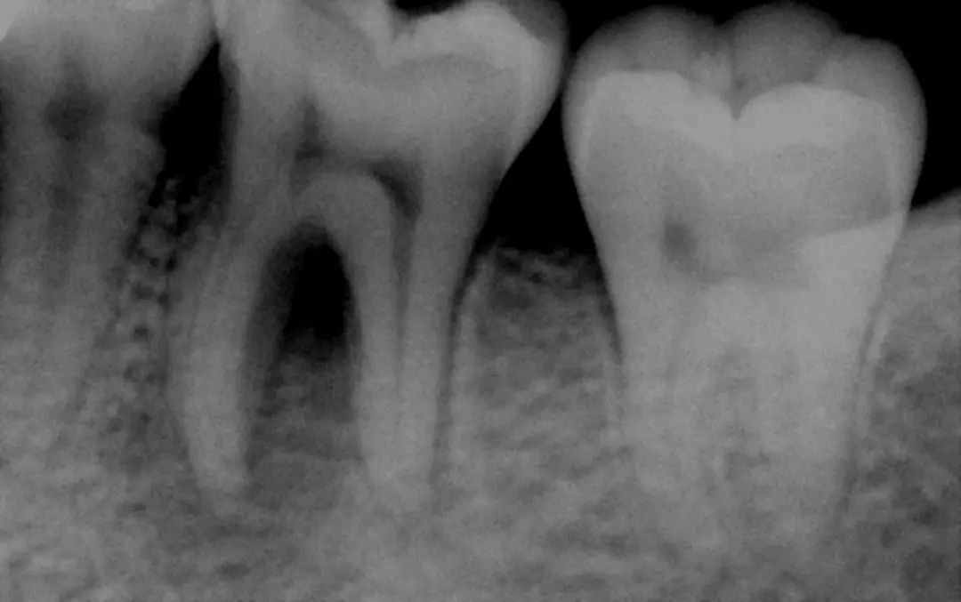 孩子换牙期不要忽略这些问题,孩子要换牙该注意什么