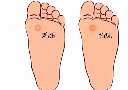 千万不要用鸡眼膏治疗跖疣,鸡眼跖疣到底怎么分辨