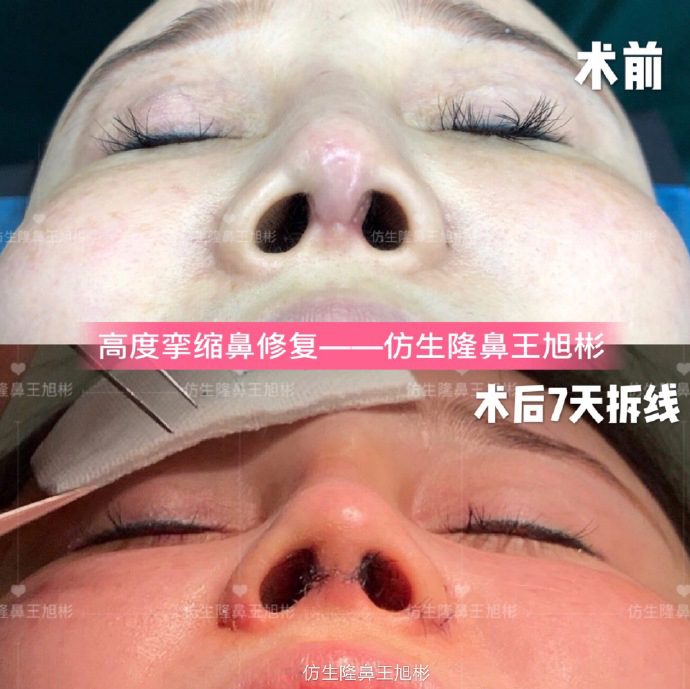 骨粉注射隆鼻皮肤变薄怎么办,线雕隆鼻会引起鼻挛缩吗