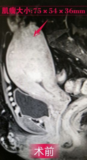 消除子宫肌瘤的特效药,消除子宫肌瘤最好中药